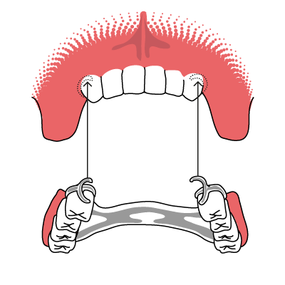 klammerprothese Veranschaulichung der Funktionsweise einer Klammerprothese